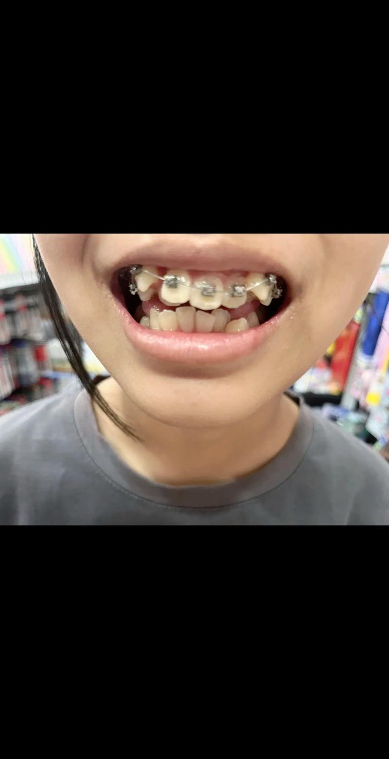 正畸三个月露牙龈-图2