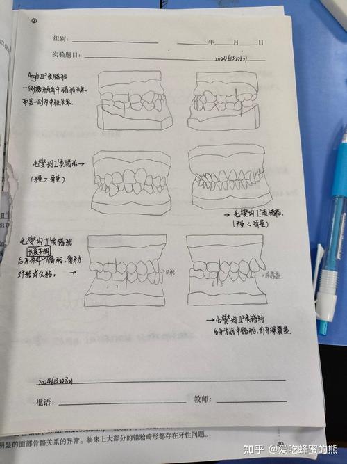 正畸安氏三类分型-图1 正畸安氏三类分型-图1