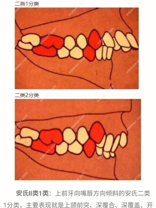 正畸安氏三类分型-图2 正畸安氏三类分型-图2