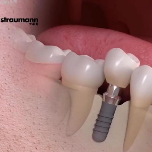 iti植牙-图2
