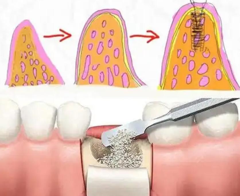 牙周植骨术，骨再生后牙齿能稳固多久？-图2