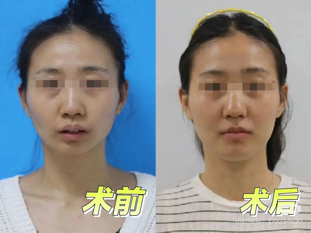 骨性错颌二类正畸-图3