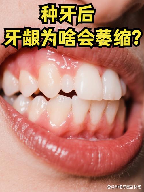 牙龈萎缩还能种牙吗？种牙需注意哪些问题？-图2