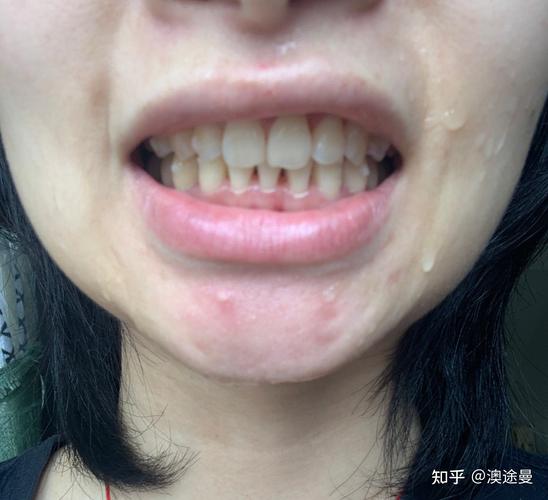 正畸下牙只拔一颗-图1