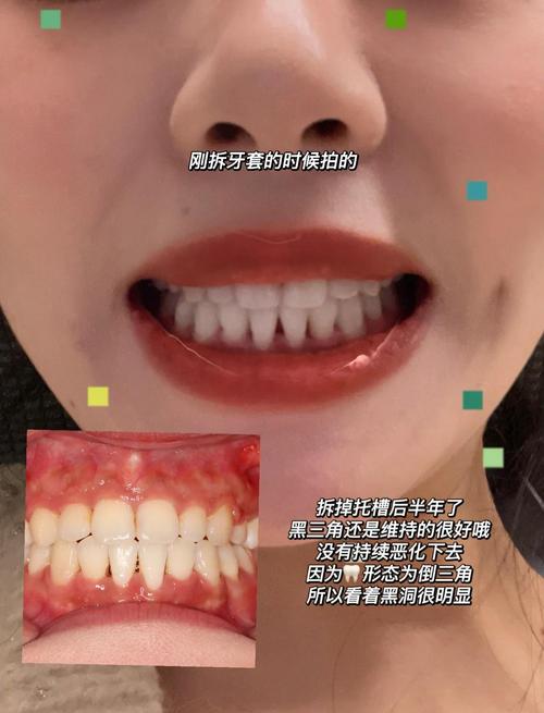 正畸根控 黑三角-图2