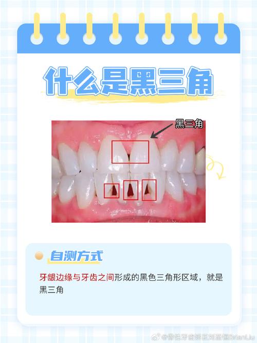 正畸根控 黑三角-图3