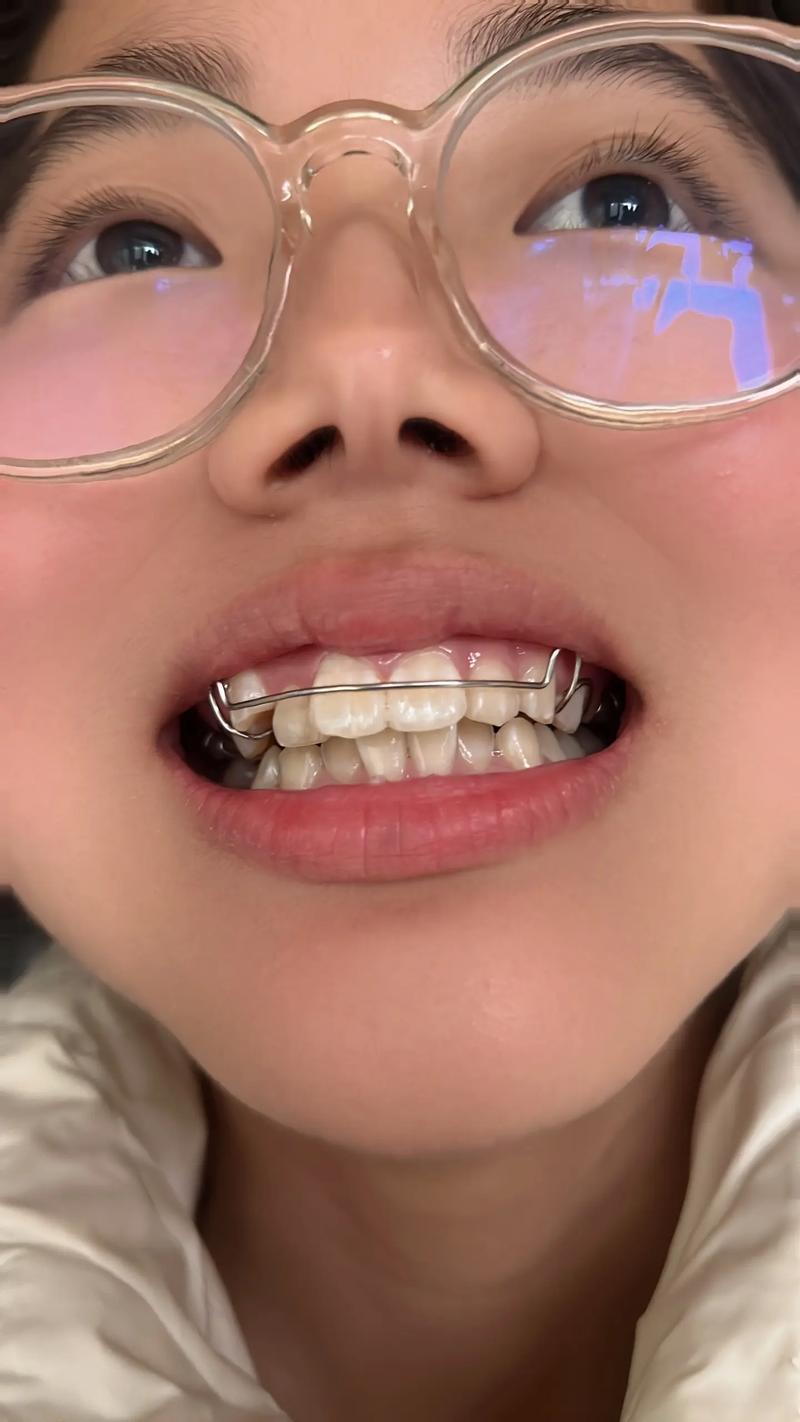八岁做牙齿正畸扩弓，时机合适吗？效果如何？-图2