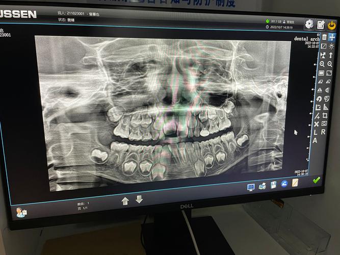 八岁做牙齿正畸扩弓，时机合适吗？效果如何？-图3