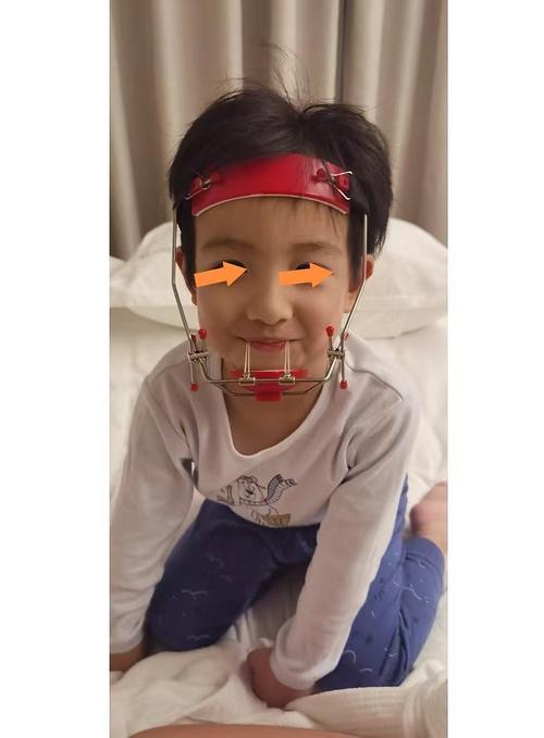 直丝弓正畸矫正器-图2 直丝弓正畸矫正器-图2