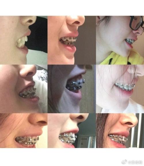 地包天正畸拔上牙-图3 地包天正畸拔上牙-图3