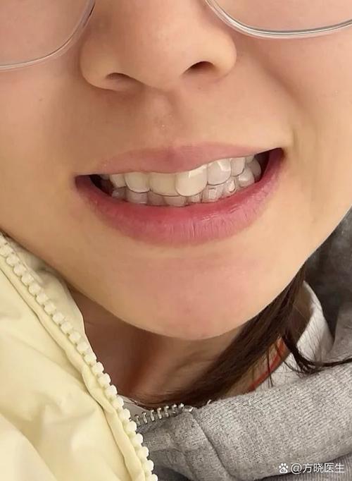 下牙正畸拔一颗牙-图3