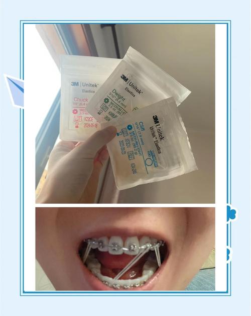 正畸橡皮圈有何用？正畸中如何正确使用？-图1