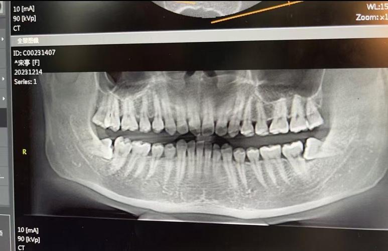 做正畸要拍片子么-图3