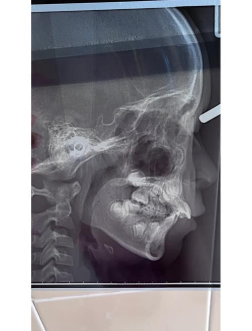 做正畸要拍片子么-图2