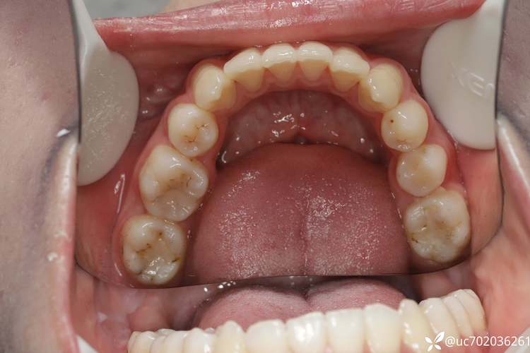 正畸二类错颌畸形矫正,有哪些关键问题需注意?-图1 正畸二类错颌畸形矫正,有哪些关键问题需注意?-图1