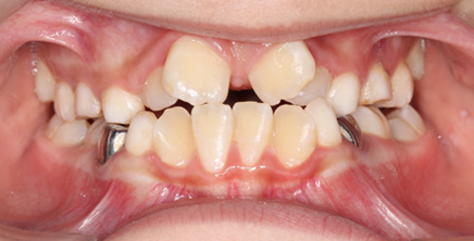 正畸二类错颌畸形矫正,有哪些关键问题需注意?-图2 正畸二类错颌畸形矫正,有哪些关键问题需注意?-图2