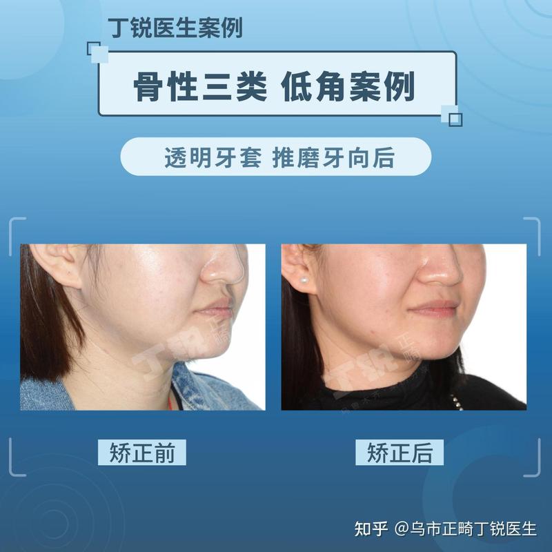 口腔正畸骨性三类-图2 口腔正畸骨性三类-图2