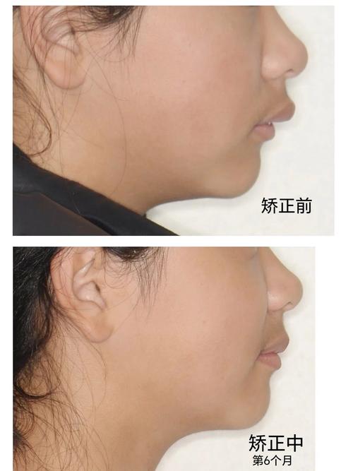 下颌牙正畸后唇倾-图1