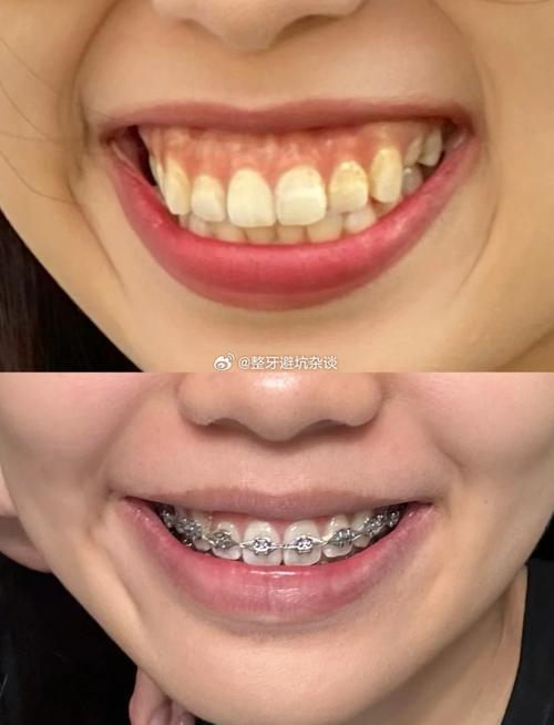 正畸过程中露龈笑-图2