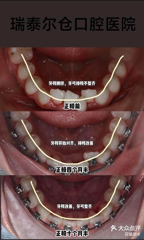 正畸过程中露龈笑-图1