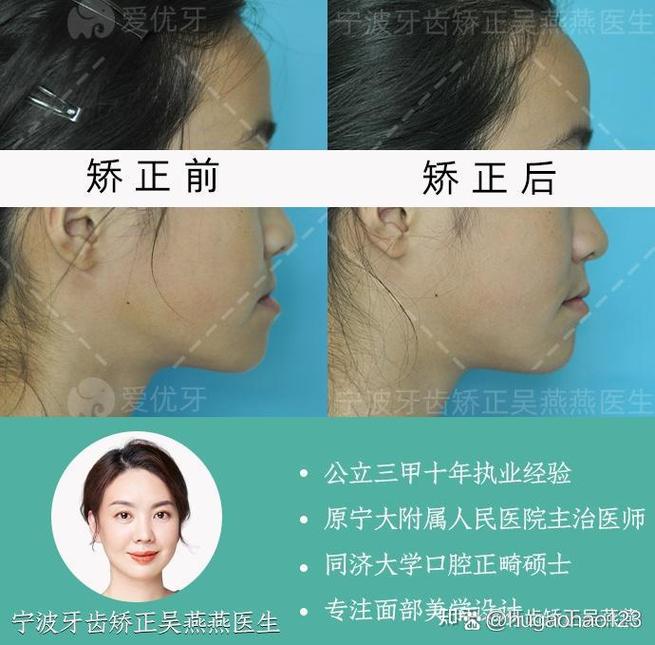 安氏一类正畸真的没用?治疗效果遭质疑?-图1 安氏一类正畸真的没用?治疗效果遭质疑?-图1