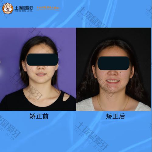 安氏一类正畸真的没用?治疗效果遭质疑?-图2 安氏一类正畸真的没用?治疗效果遭质疑?-图2