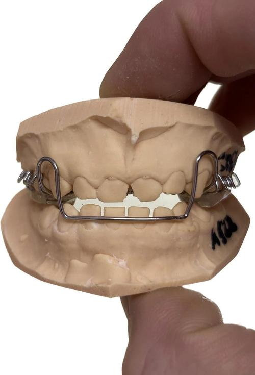 正畸推簧矫正器图-图1