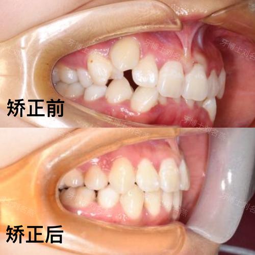 拔三个正畸牙案例-图3