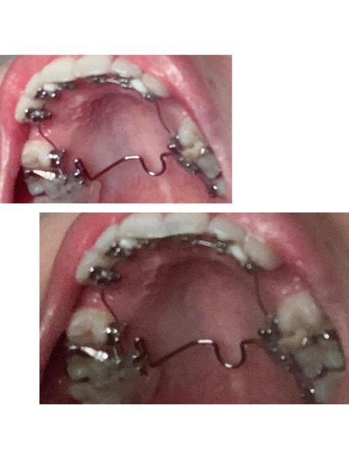 二线城市舌侧正畸价格贵吗？效果会比托槽好吗？-图2
