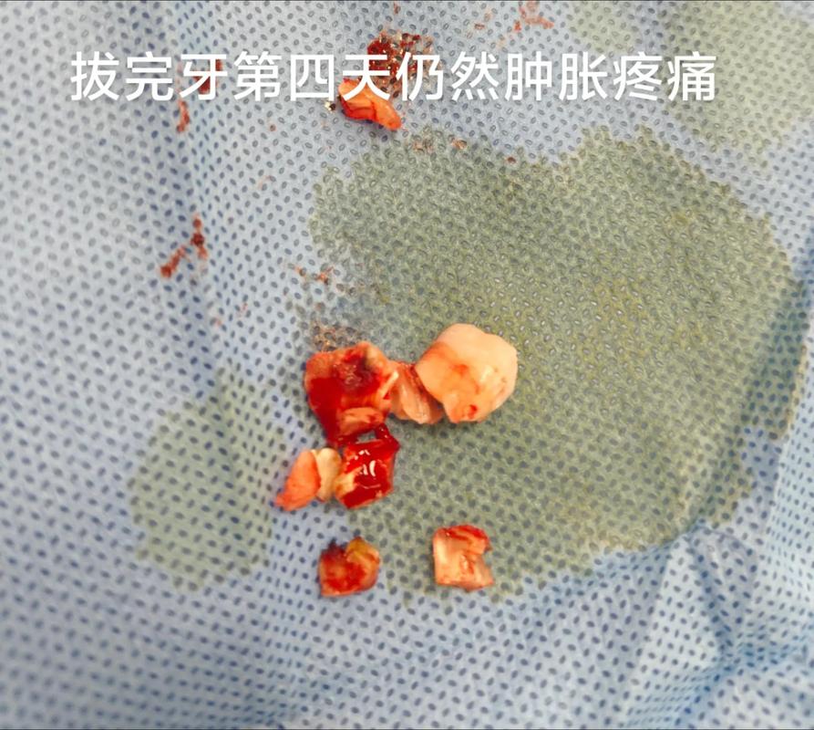 正畸前拔四颗智齿-图2 正畸前拔四颗智齿-图2