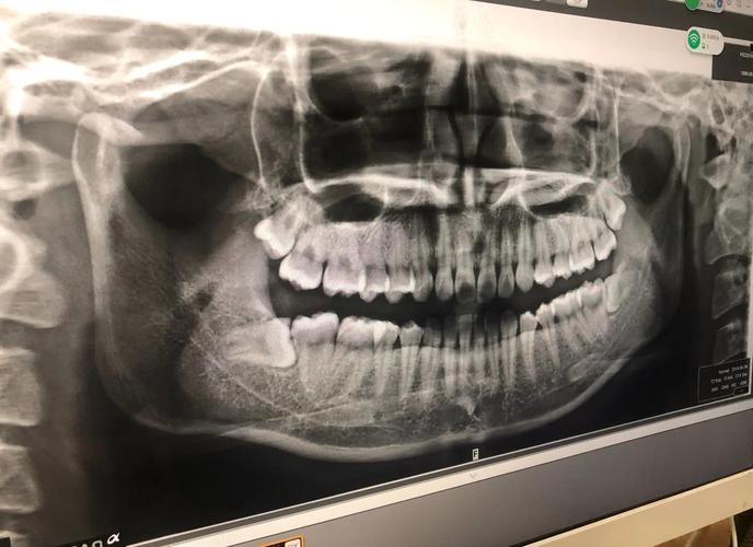 正畸前拔四颗智齿-图3 正畸前拔四颗智齿-图3