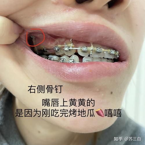 嘴突正畸是否都需要骨钉?正畸医生详解适用条件-图3 嘴突正畸是否都需要骨钉?正畸医生详解适用条件-图3
