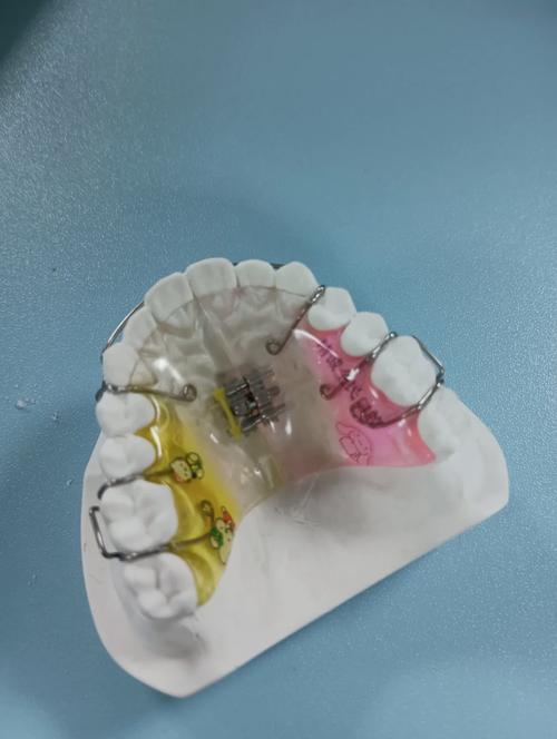 正畸颌垫推簧弯制-图2 正畸颌垫推簧弯制-图2