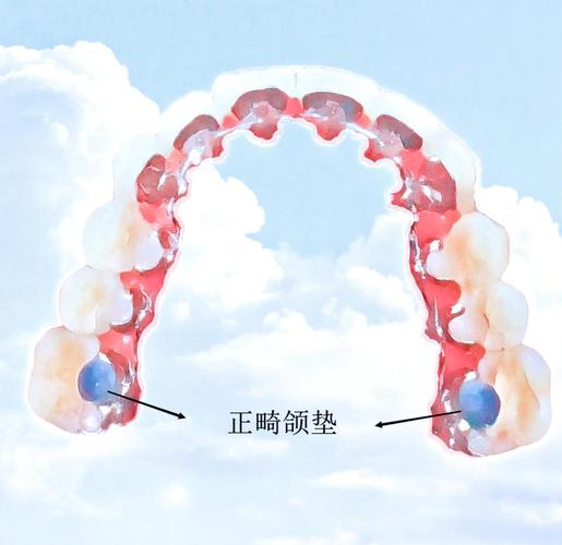 正畸颌垫推簧弯制-图3 正畸颌垫推簧弯制-图3