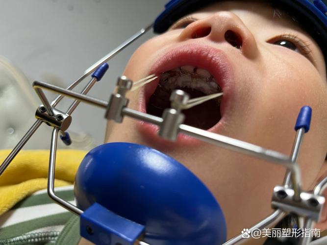 反颌正畸3D视频-图1