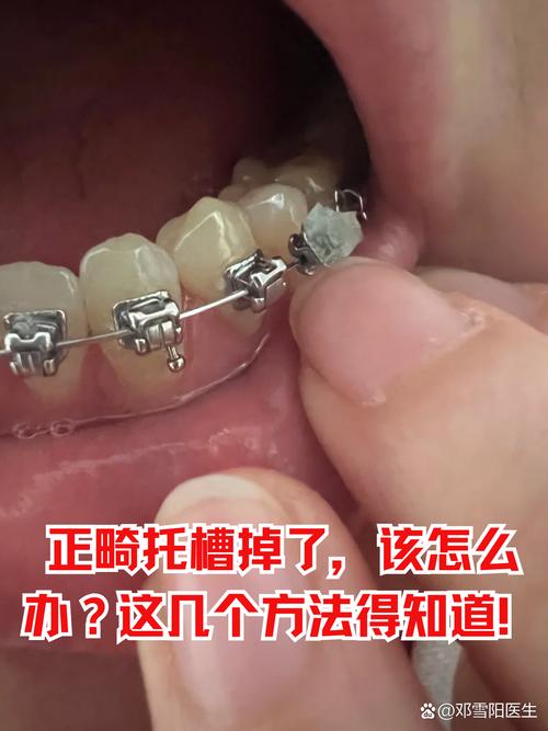 矫正器老往下掉,是粘接不牢还是佩戴不当?要紧吗?-图1 矫正器老往下掉,是粘接不牢还是佩戴不当?要紧吗?-图1