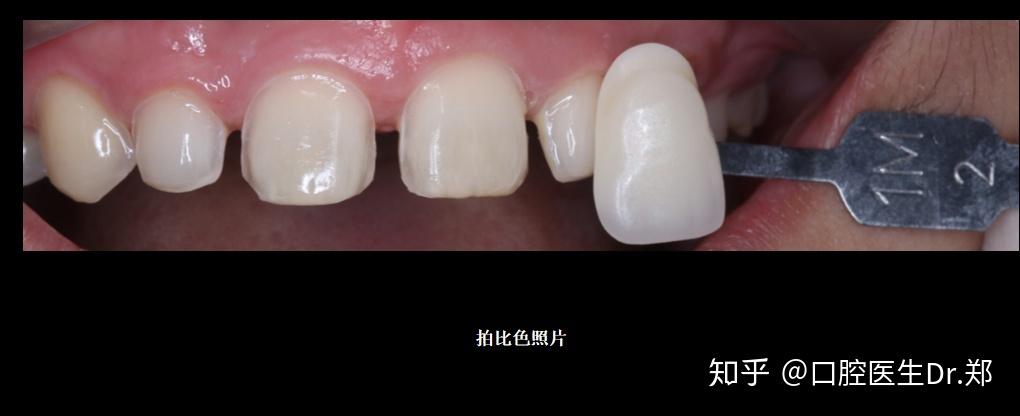 正畸后黑三角，牙贴面修复效果如何？-图1