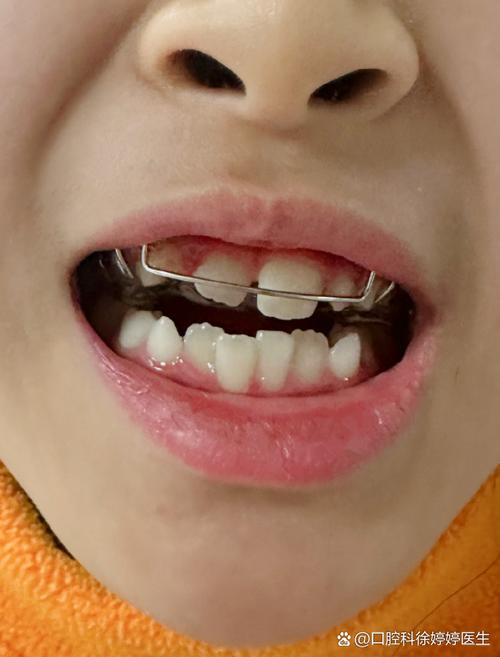 正畸6毫米明显吗-图1