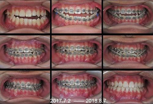 正畸全同步带状弓-图1