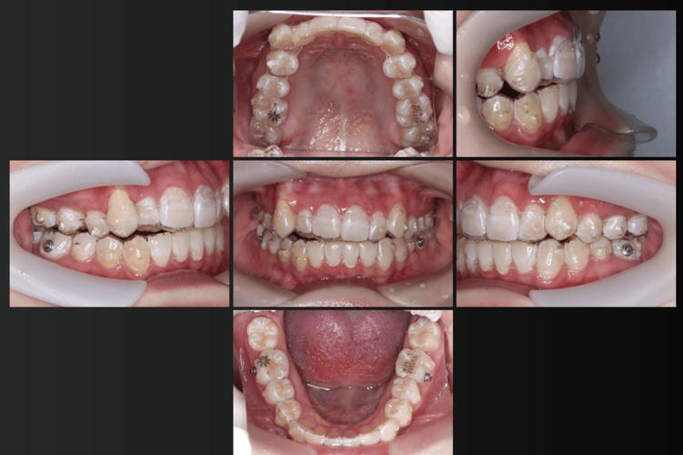 安氏三类正畸预后的关键影响因素有哪些？-图2