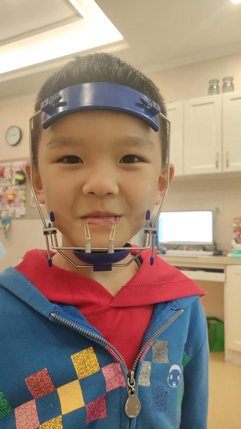 正畸牵引器一般要戴多久？具体时长因人而异吗？-图3