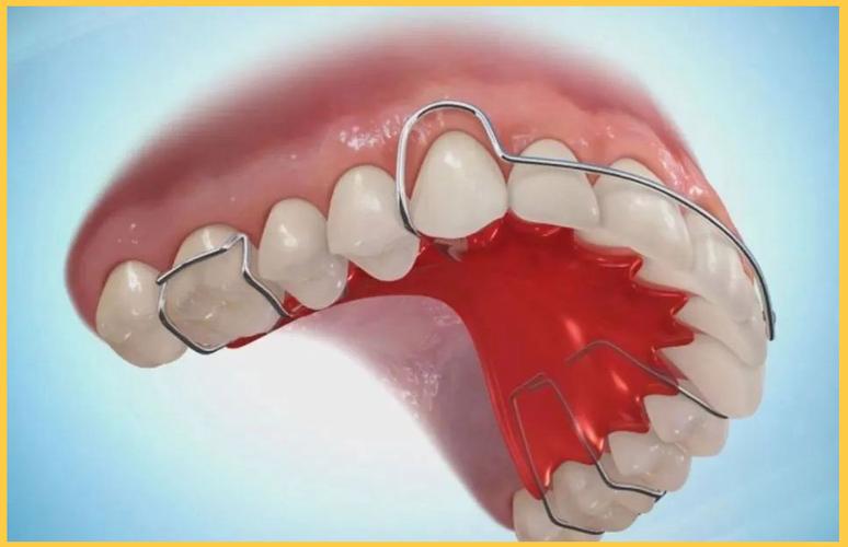 正畸大牙上的颊管是什么？正畸中为何重要？-图2