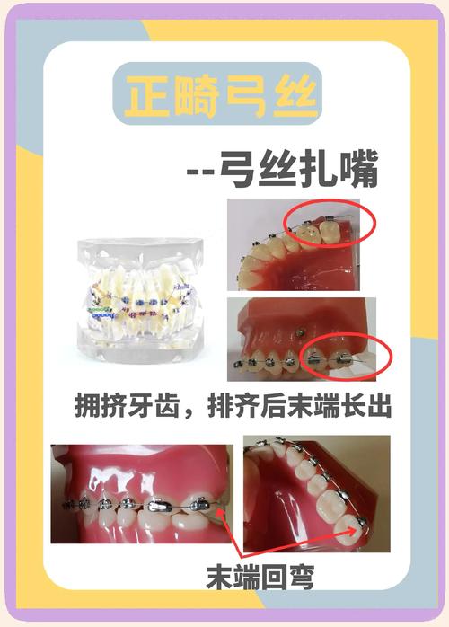 正畸弓丝打开间隙-图1