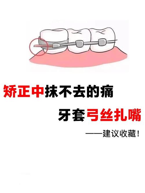 正畸弓丝打开间隙-图2