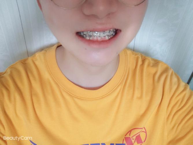 美奥口腔正畸效果如何?价格与服务值得信赖吗?-图2 美奥口腔正畸效果如何?价格与服务值得信赖吗?-图2