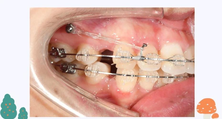 正畸支抗钉 a1-图2