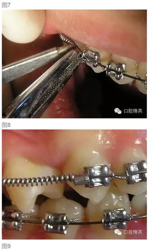 上推簧非拔牙正畸，如何避免拔牙又能有效矫正牙齿？-图3