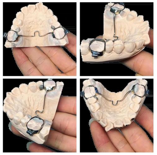 正畸腭杠腭托的制作方法与操作步骤是怎样的？-图1