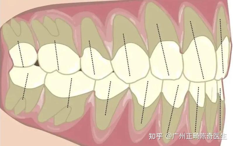 二次正畸复发概率高吗？如何科学降低复发风险？-图2