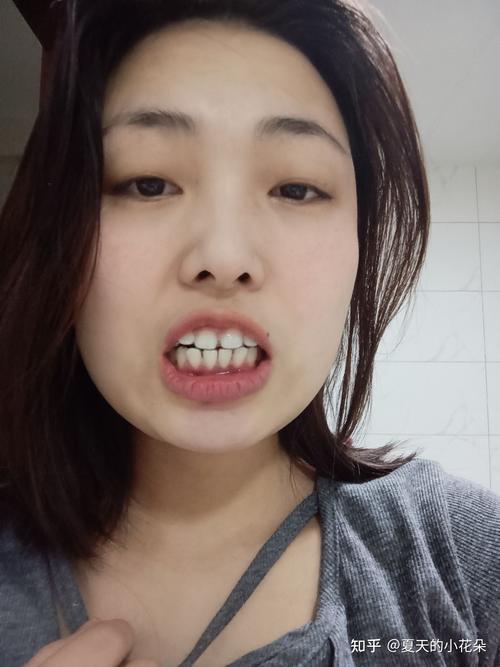 二次正畸复发概率高吗？如何科学降低复发风险？-图3